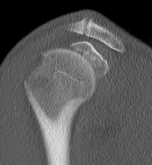 CT GT Fracture Sagittal